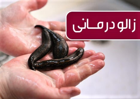 دوره زالو درمانی